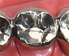 奥歯金銀パラジウム