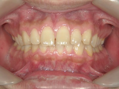 症例紹介１すきっ歯がコンプレックスでした。